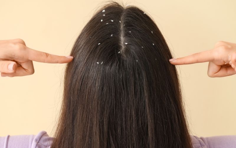 Sintomas além do couro cabeludo